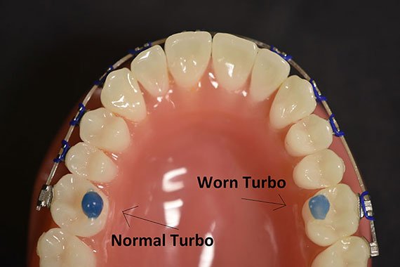 How to Remove Bite Blocks Braces